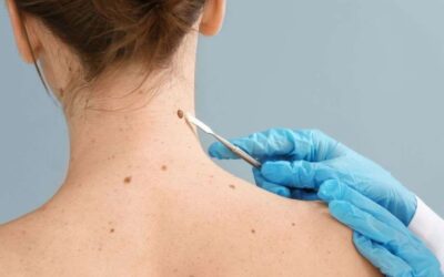 Este 13 de junio es el Día Mundial del Cáncer de Piel, ¿por qué surge?