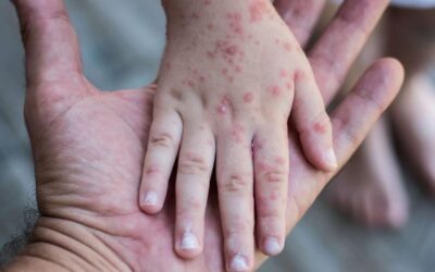 Salud emite alerta epidemiológica por riesgo de sarampión tras evento masivo en Sololá