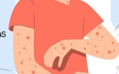 Autoridades confirman brote activo de sarampión y llaman a reforzar la vacunación en el país